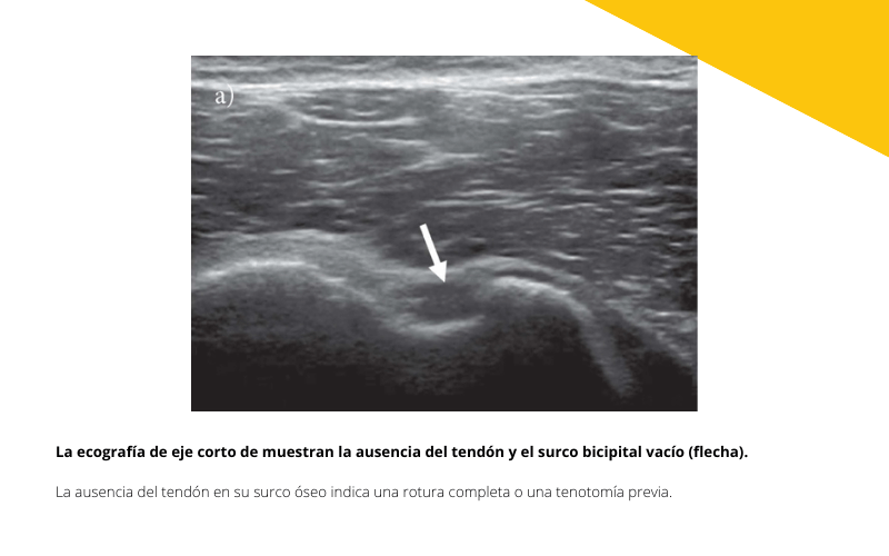 5.  Ecografia Tendon largo biceps tempo formacion.png